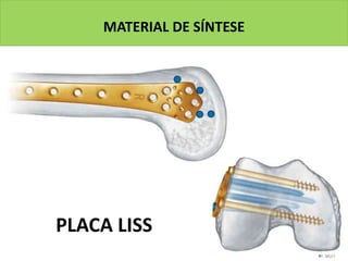 MATERIAL DE SÍNTESE
PLACA LISS
 