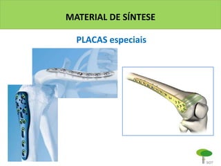 MATERIAL DE SÍNTESE
PLACAS especiais
 