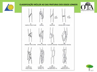 CLASSIFICAÇÃO MÜLLER AO DAS FRATURAS DOS OSSOS LONGOS
 