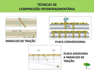 TÉCNICAS DE
COMPRESSÃO INTERFRAGMENTÁRIA
PARAFUSO DE TRAÇÃO PLACA CONVENCIONAL
PLACA ASSOCIADA
A PARAFUSO DE
TRAÇÃO
 