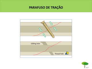 PARAFUSO DE TRAÇÃO
 