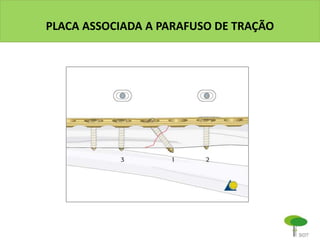 PLACA ASSOCIADA A PARAFUSO DE TRAÇÃO
 