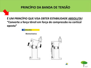 PRINCÍPIO DA BANDA DE TENSÃO
É UM PRINCÍPIO QUE VISA OBTER ESTABILIDADE ABSOLUTA!
“Converte a força tênsil em força de compressão na cortical
oposta”
 