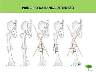PRINCÍPIO DA BANDA DE TENSÃO
 