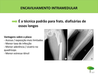 ENCAVILHAMENTO INTRAMEDULAR
É a técnica padrão para frats. diafisárias de
ossos longos
Vantagens sobre a placa:
- Acesso / exposição mais limitados
- Menor taxa de infecção
- Menor aderência / cicatriz no
quadríceps
- Menor estresse tênsil
 