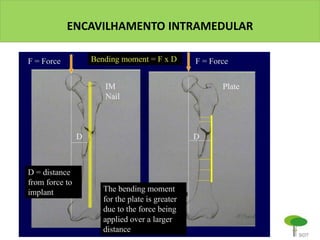 ENCAVILHAMENTO INTRAMEDULAR
 