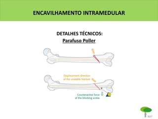 ENCAVILHAMENTO INTRAMEDULAR
DETALHES TÉCNICOS:
Parafuso Poller
 