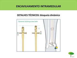 ENCAVILHAMENTO INTRAMEDULAR
DETALHES TÉCNICOS: bloqueio dinâmico
 