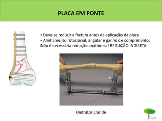 PLACA EM PONTE
• Deve-se reduzir a fratura antes da aplicação da placa
- Alinhamento rotacional, angular e ganho de comprimento:
Não é necessária redução anatômica! REDUÇÃO INDIRETA.
Distrator grande
 