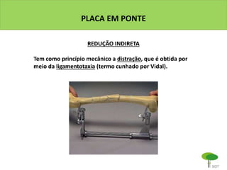 PLACA EM PONTE
REDUÇÃO INDIRETA
Tem como princípio mecânico a distração, que é obtida por
meio da ligamentotaxia (termo cunhado por Vidal).
 