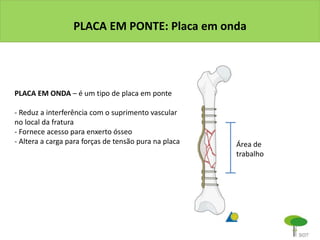 PLACA EM PONTE: Placa em onda
Área de
trabalho
PLACA EM ONDA – é um tipo de placa em ponte
- Reduz a interferência com o suprimento vascular
no local da fratura
- Fornece acesso para enxerto ósseo
- Altera a carga para forças de tensão pura na placa
 