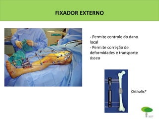 FIXADOR EXTERNO
- Permite controle do dano
local
- Permite correção de
deformidades e transporte
ósseo
Orthofix®
 