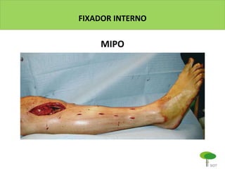 FIXADOR INTERNO
MIPO
 