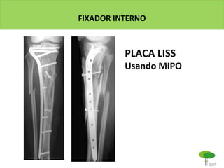 FIXADOR INTERNO
PLACA LISS
Usando MIPO
 