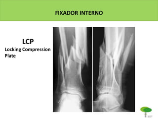 FIXADOR INTERNO
LCP
Locking Compression
Plate
 