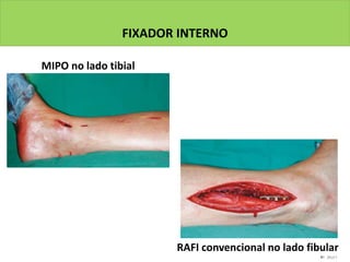 FIXADOR INTERNO
MIPO no lado tibial
RAFI convencional no lado fibular
 