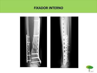 FIXADOR INTERNO
 