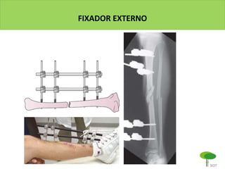 FIXADOR EXTERNO
 