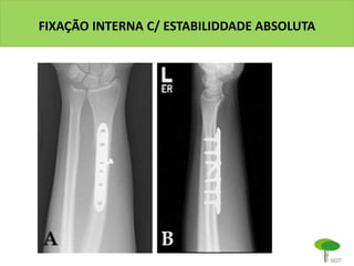 FIXAÇÃO INTERNA C/ ESTABILIDDADE ABSOLUTA
 