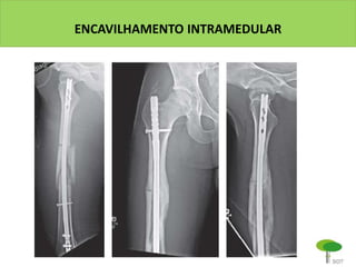 ENCAVILHAMENTO INTRAMEDULAR
 