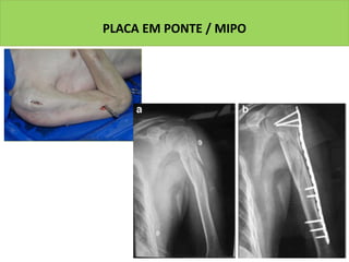 PLACA EM PONTE / MIPO
 