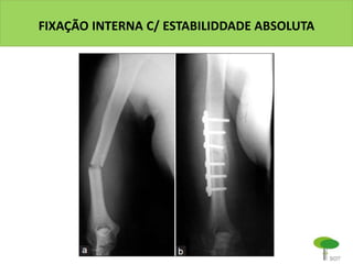FIXAÇÃO INTERNA C/ ESTABILIDDADE ABSOLUTA
 