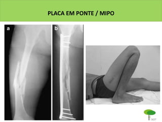 PLACA EM PONTE / MIPO
 