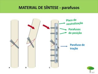 MATERIAL DE SÍNTESE - parafusos
Parafusos
de posição
Parafuso de
tração
 