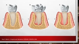 Gay C, Berini L. Cirugía bucal. Barcelona: OCÉANO / ERGÓN; 2004
 