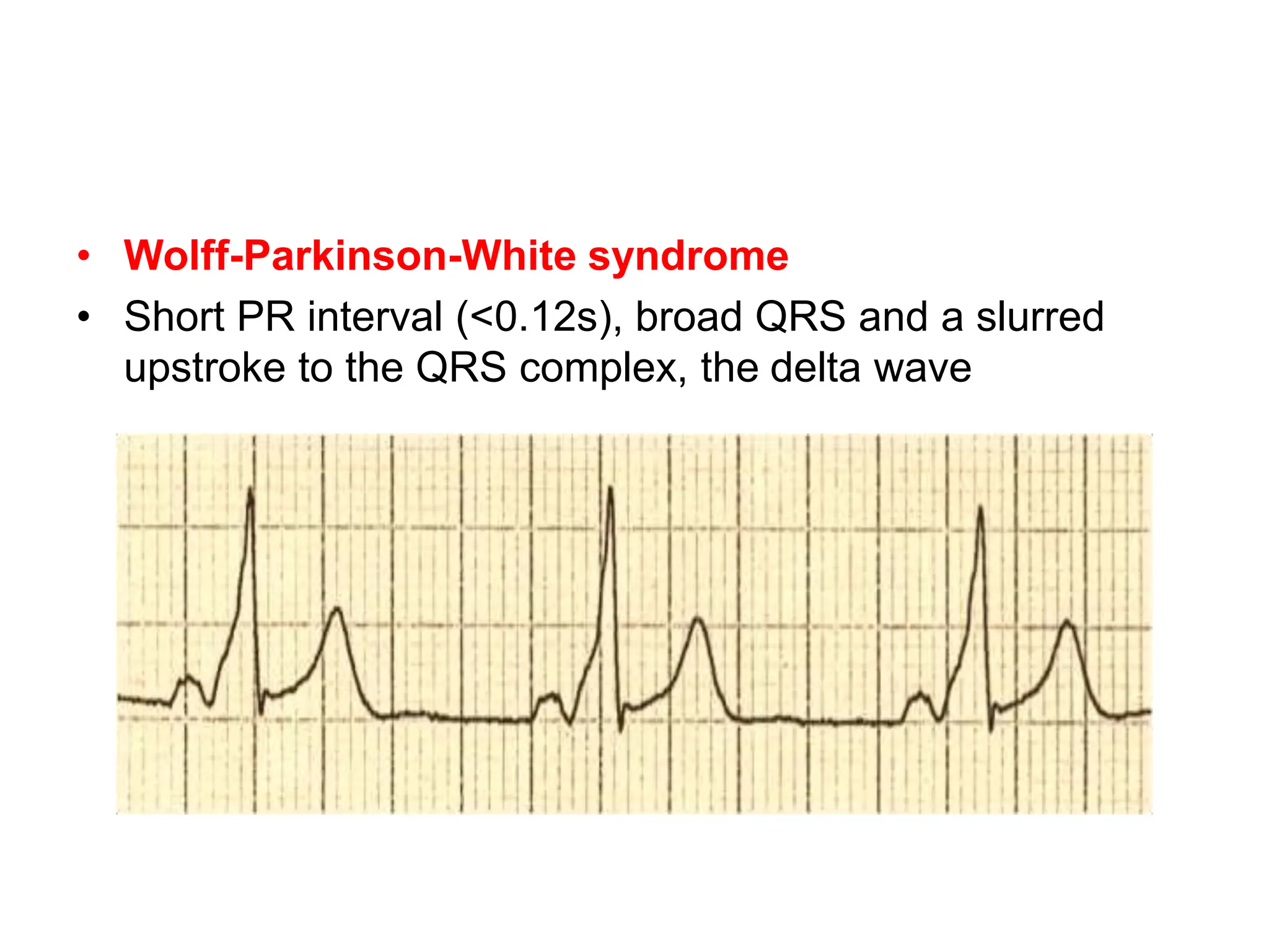 • Wolff-Parkinson-White syndrome
• Short PR interval (<0.12s), broad QRS and a slurred
upstroke to the QRS complex, the delta wave
 