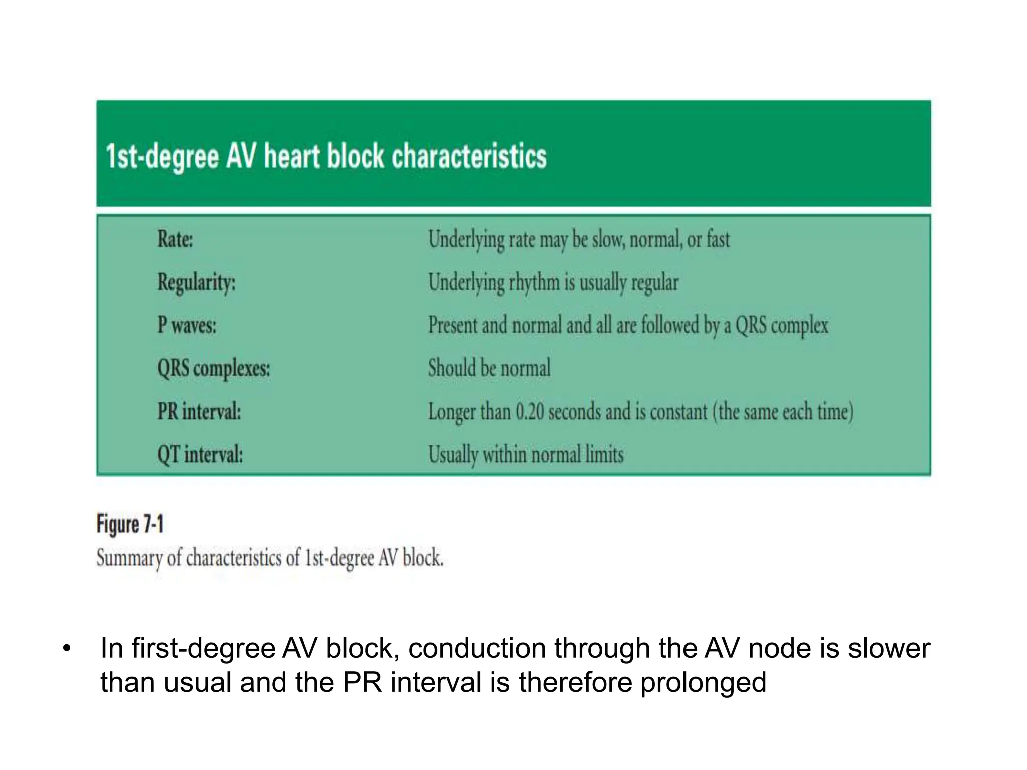 • In first-degree AV block, conduction through the AV node is slower
than usual and the PR interval is therefore prolonged
 