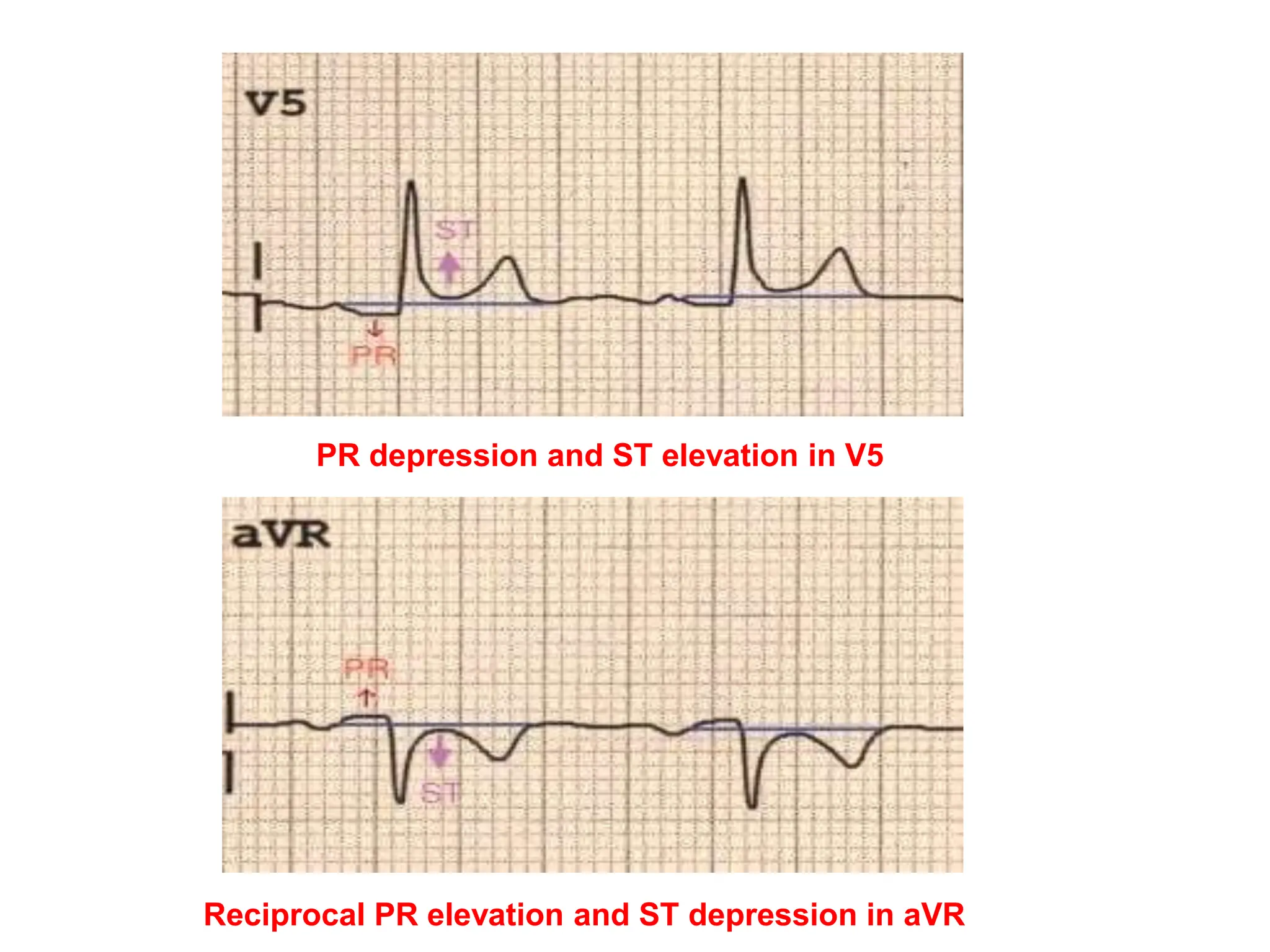 PR depression and ST elevation in V5
Reciprocal PR elevation and ST depression in aVR
 