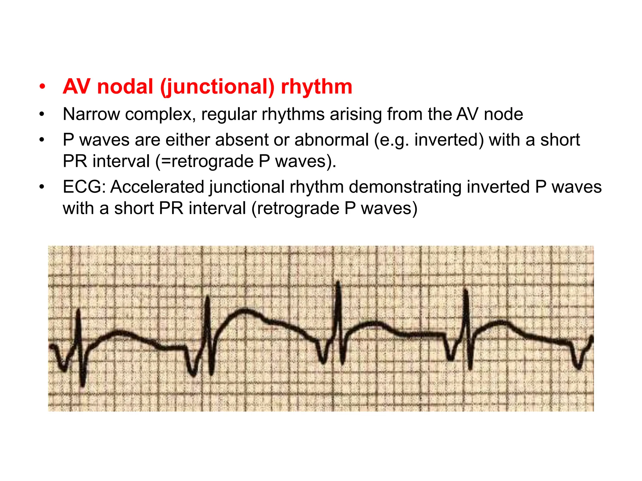• AV nodal (junctional) rhythm
• Narrow complex, regular rhythms arising from the AV node
• P waves are either absent or abnormal (e.g. inverted) with a short
PR interval (=retrograde P waves).
• ECG: Accelerated junctional rhythm demonstrating inverted P waves
with a short PR interval (retrograde P waves)
 