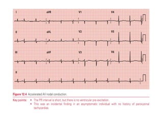 PR INTERVAL,CAUSES OF SHORT AND LONG PR INTERVAL | PPTX