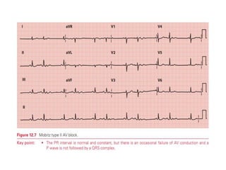 PR INTERVAL,CAUSES OF SHORT AND LONG PR INTERVAL | PPTX