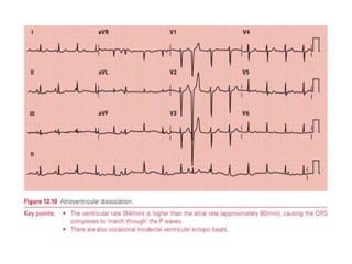 PR INTERVAL,CAUSES OF SHORT AND LONG PR INTERVAL | PPTX