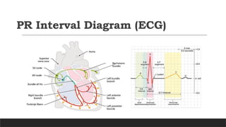 PR INTERVAL ECG. Pr interval ecg criteria | PPTX