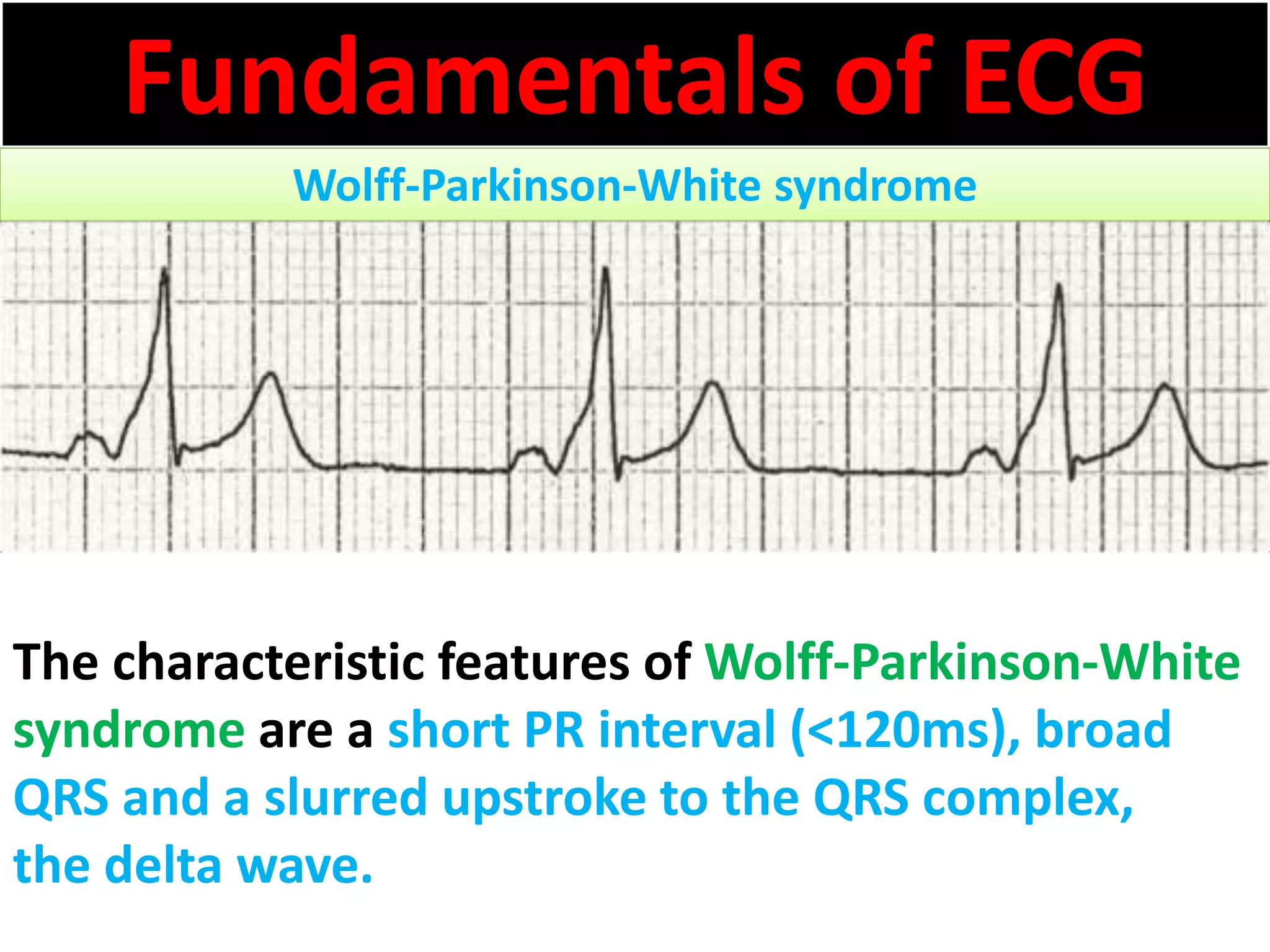 Fundamentals of ECG
Wolff-Parkinson-White syndrome
The characteristic features of Wolff-Parkinson-White
syndrome are a short PR interval (<120ms), broad
QRS and a slurred upstroke to the QRS complex,
the delta wave.
 
