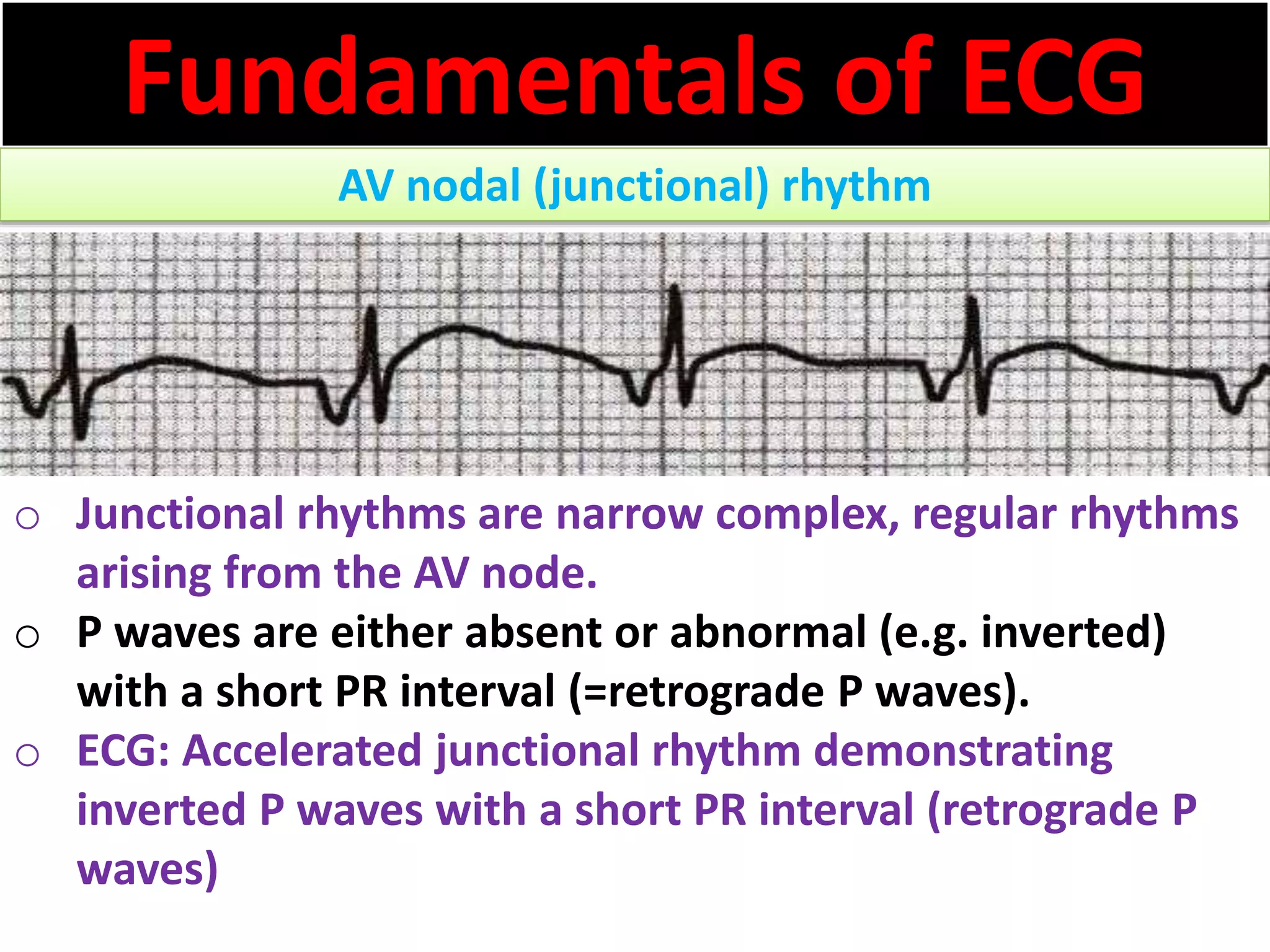 Fundamentals of ECG
AV nodal (junctional) rhythm
o Junctional rhythms are narrow complex, regular rhythms
arising from the AV node.
o P waves are either absent or abnormal (e.g. inverted)
with a short PR interval (=retrograde P waves).
o ECG: Accelerated junctional rhythm demonstrating
inverted P waves with a short PR interval (retrograde P
waves)
 