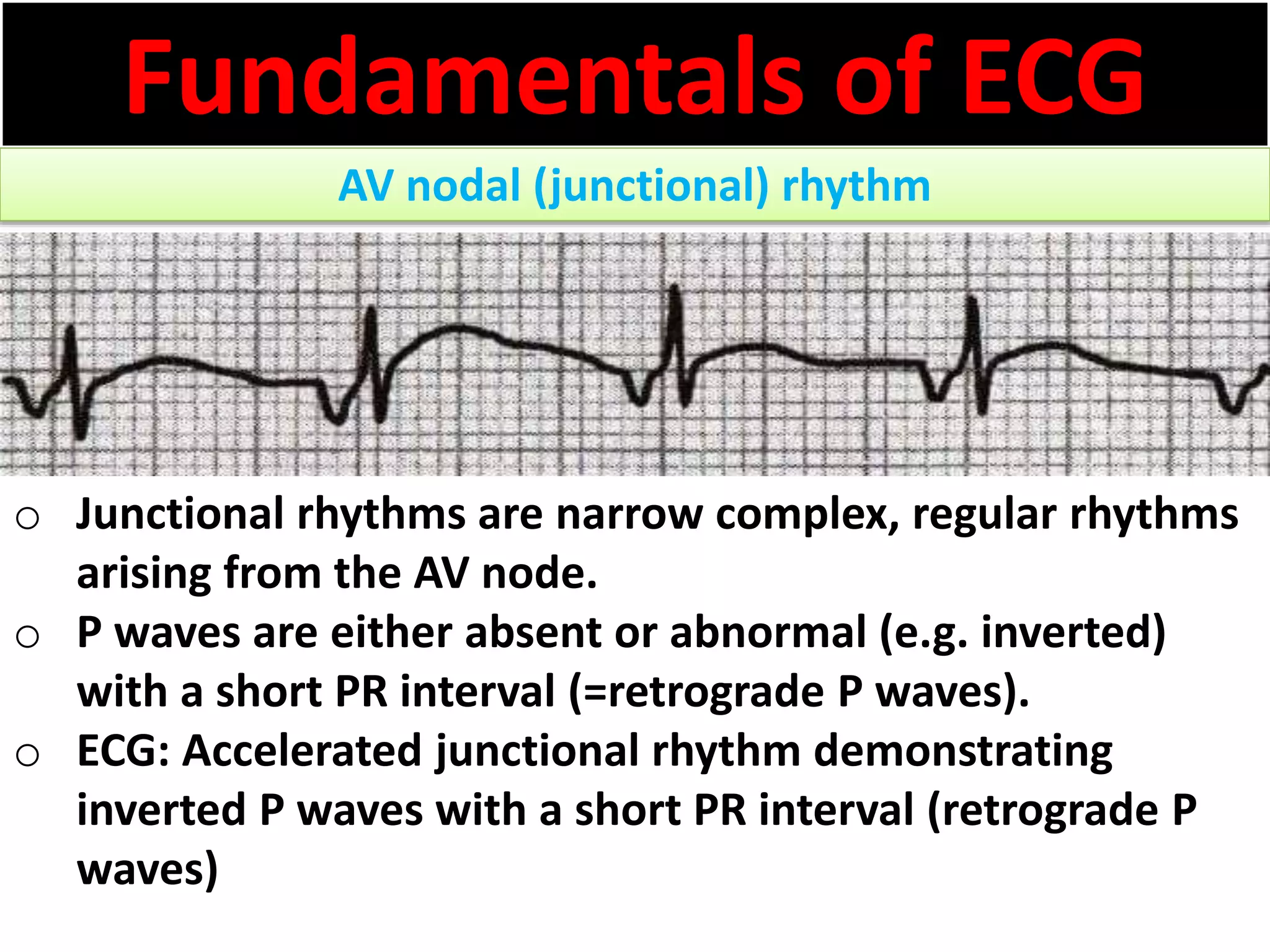Fundamentals of ECG
AV nodal (junctional) rhythm
o Junctional rhythms are narrow complex, regular rhythms
arising from the AV node.
o P waves are either absent or abnormal (e.g. inverted)
with a short PR interval (=retrograde P waves).
o ECG: Accelerated junctional rhythm demonstrating
inverted P waves with a short PR interval (retrograde P
waves)
 