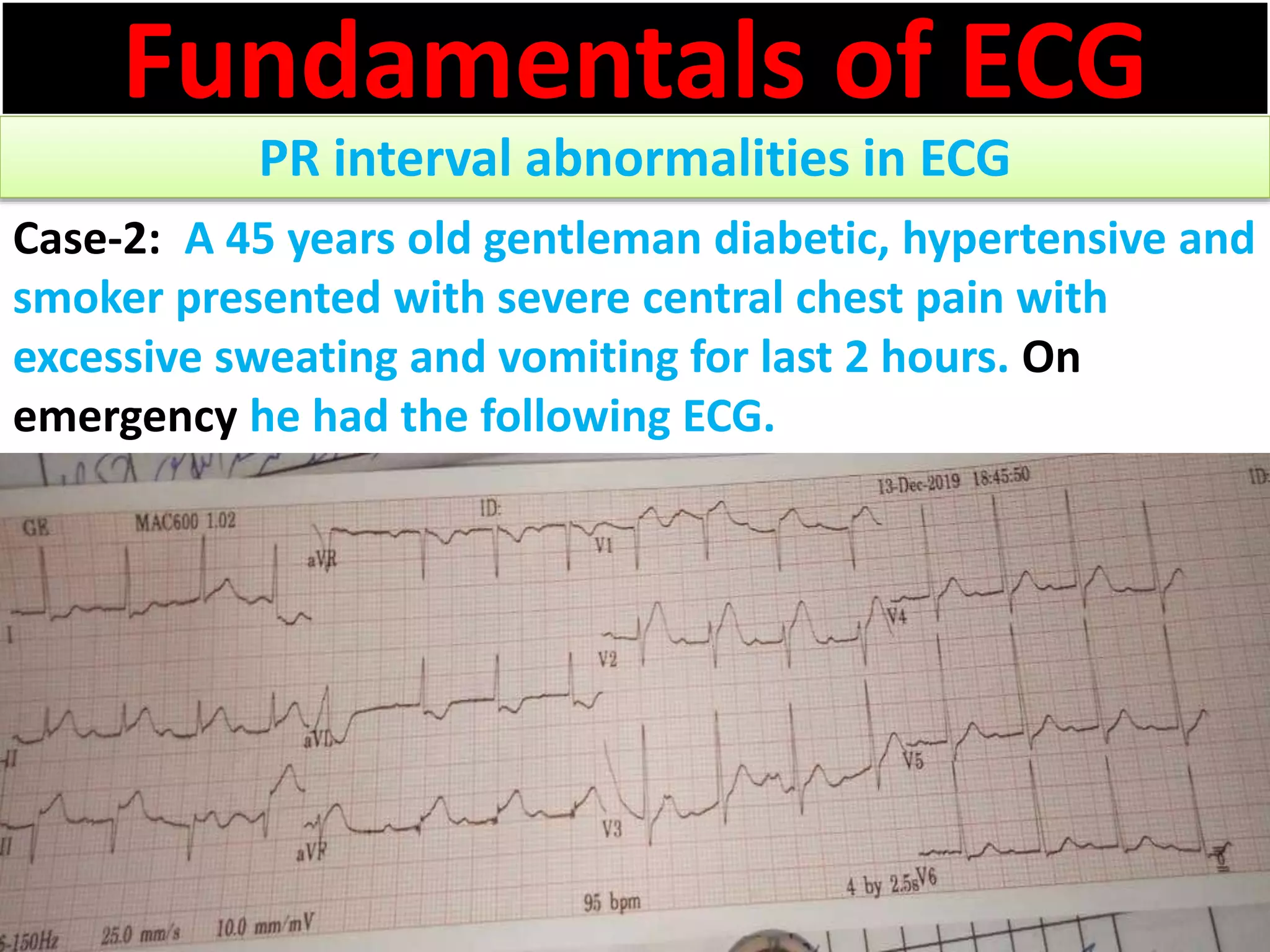 Fundamentals of ECG
PR interval abnormalities in ECG
Case-2: A 45 years old gentleman diabetic, hypertensive and
smoker presented with severe central chest pain with
excessive sweating and vomiting for last 2 hours. On
emergency he had the following ECG.
 
