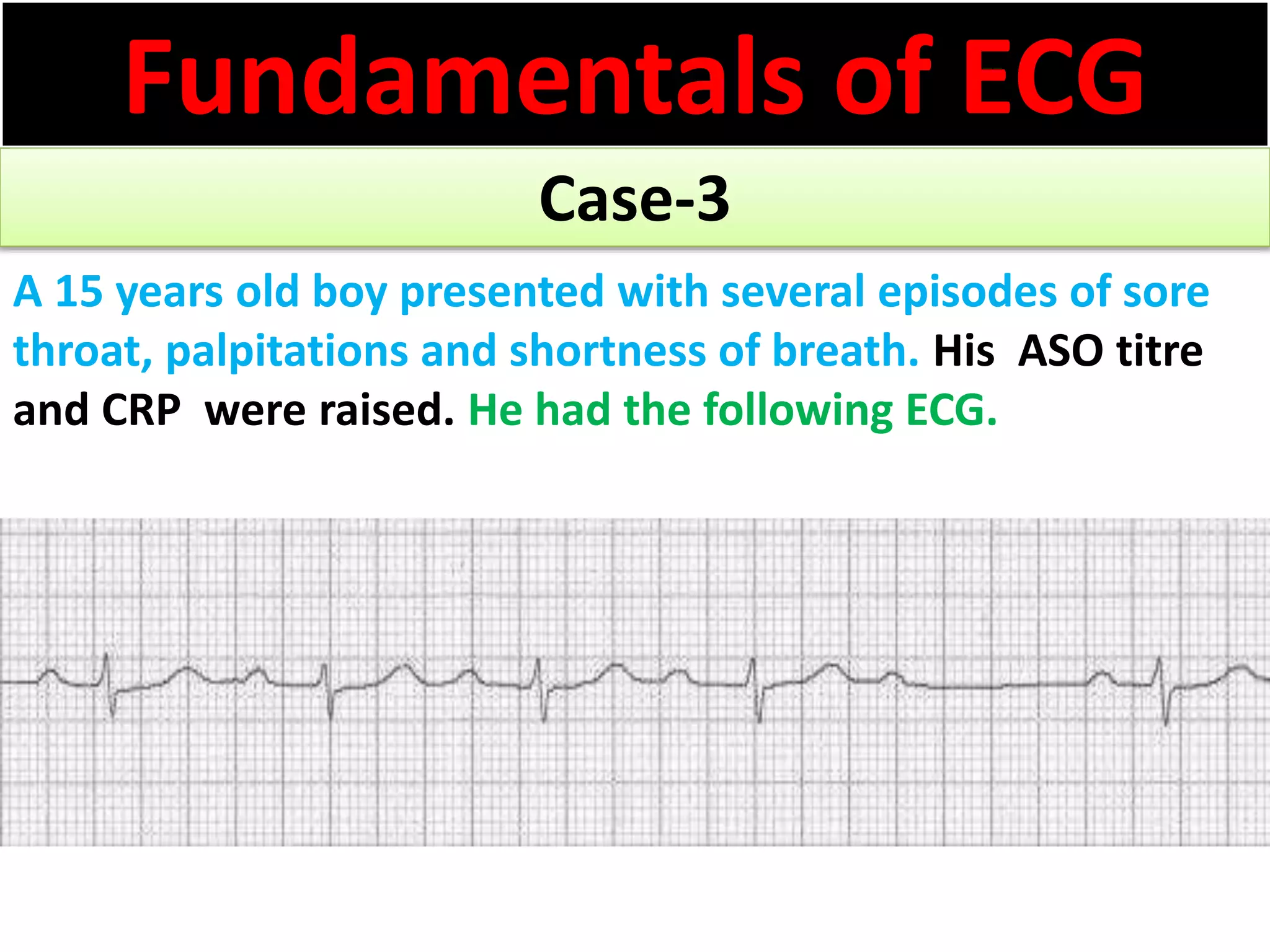 Fundamentals of ECG
Case-3
A 15 years old boy presented with several episodes of sore
throat, palpitations and shortness of breath. His ASO titre
and CRP were raised. He had the following ECG.
 