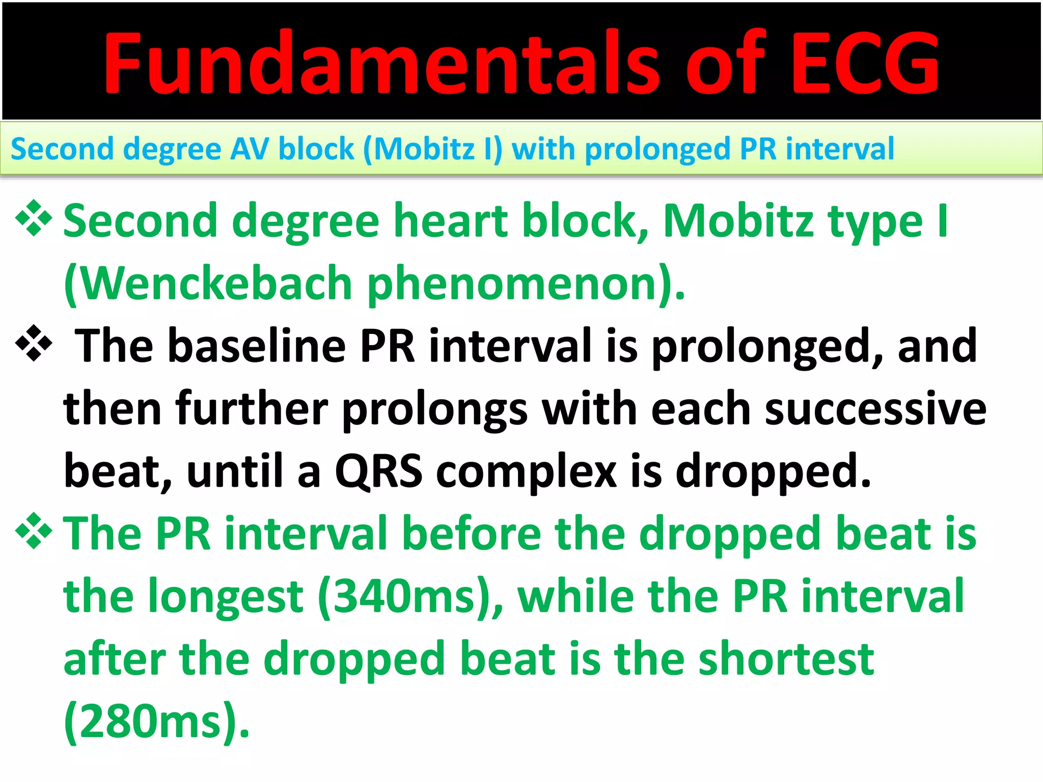Fundamentals of ECG
Second degree AV block (Mobitz I) with prolonged PR interval
Second degree heart block, Mobitz type I
(Wenckebach phenomenon).
 The baseline PR interval is prolonged, and
then further prolongs with each successive
beat, until a QRS complex is dropped.
The PR interval before the dropped beat is
the longest (340ms), while the PR interval
after the dropped beat is the shortest
(280ms).
 
