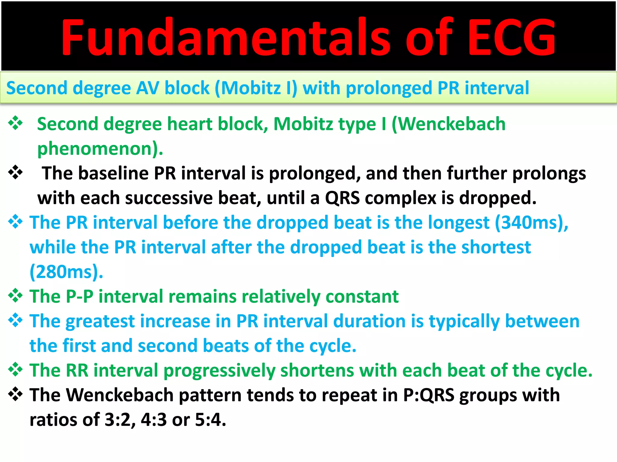 Fundamentals of ECG
Second degree AV block (Mobitz I) with prolonged PR interval
 Second degree heart block, Mobitz type I (Wenckebach
phenomenon).
 The baseline PR interval is prolonged, and then further prolongs
with each successive beat, until a QRS complex is dropped.
 The PR interval before the dropped beat is the longest (340ms),
while the PR interval after the dropped beat is the shortest
(280ms).
 The P-P interval remains relatively constant
 The greatest increase in PR interval duration is typically between
the first and second beats of the cycle.
 The RR interval progressively shortens with each beat of the cycle.
 The Wenckebach pattern tends to repeat in P:QRS groups with
ratios of 3:2, 4:3 or 5:4.
 