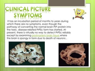It has an incubation period of months to years during
which there are no symptoms, even though the
pathway of converting the normal brain PrP protein into
the toxic, disease-related PrPSc form has started. At
present, there is virtually no way to detect PrPSc reliably
except by examining postmortem brain tissue where
the brain is spongy in form due to death of neurons .
 