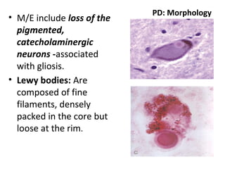 PD: Morphology
• M/E include loss of the
pigmented,
catecholaminergic
neurons -associated
with gliosis.
• Lewy bodies: Are
composed of fine
filaments, densely
packed in the core but
loose at the rim.
 