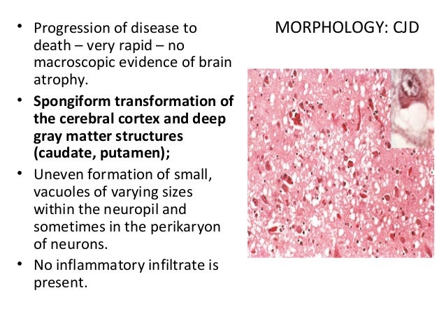 Prion disease
