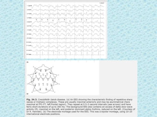 Prion diseases ---kuru | PPTX