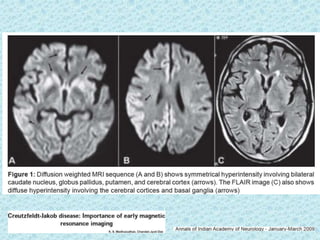 Prion diseases ---kuru | PPTX