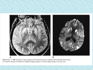 Prion diseases ---kuru | PPTX